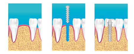 Les implant dentaires tels que pratiqués par les dentistes implantologue du centre dentaire Avenir à Neuilly sur Marne